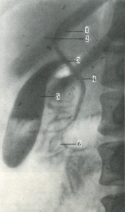 рентгенограма жовчних шляхів при холеографии