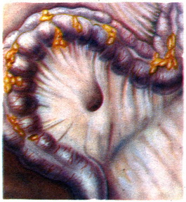 кишені брижі сигмовидної кишки