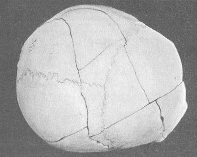 перелом кісток склепіння черепа