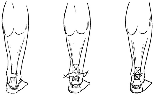 зшивання ахіллового сухожилля по Кюнео