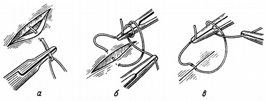 проведення мікроголки в склеральной рані