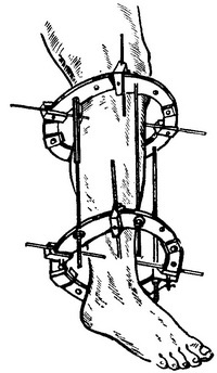 іммобілізація апаратом ілізарова
