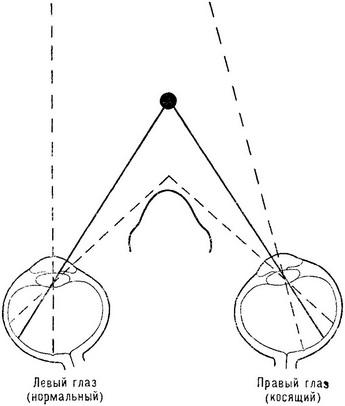 випадки косоокості