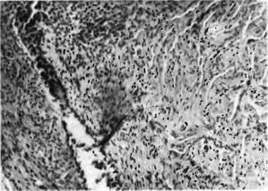 Нагноєння в зоні ендометріозу