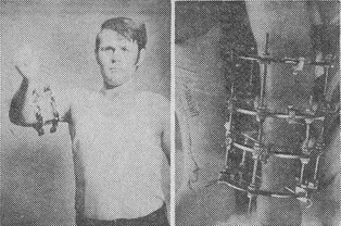 апарат Ілізарова