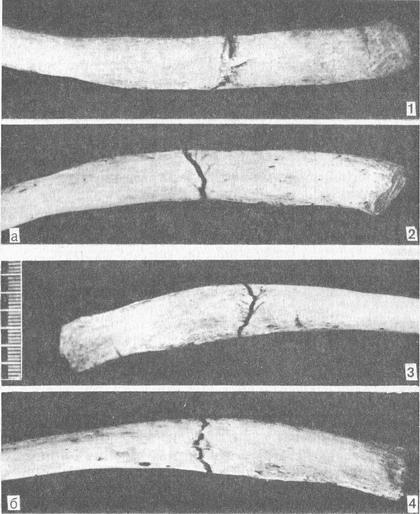 переломи ребер