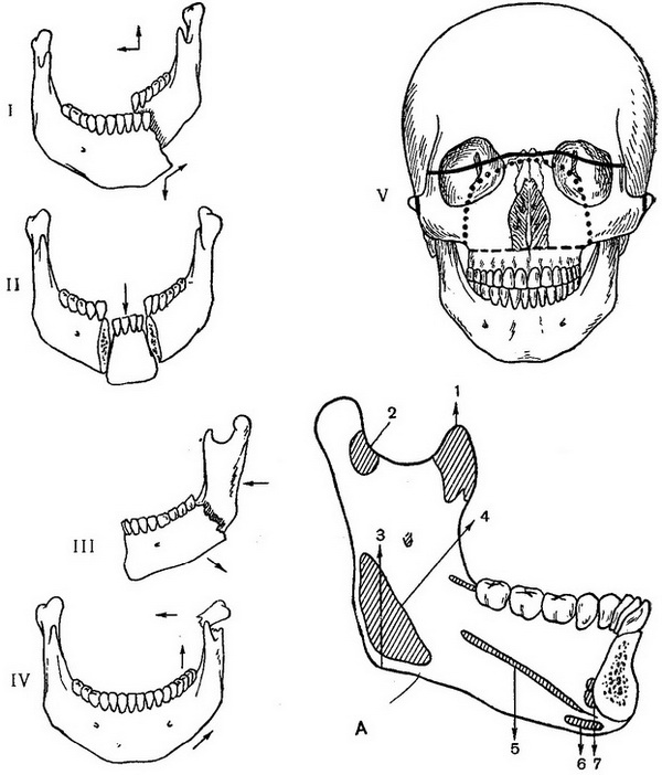 схема зміщення відламків при типових переломах нижньої щелепи