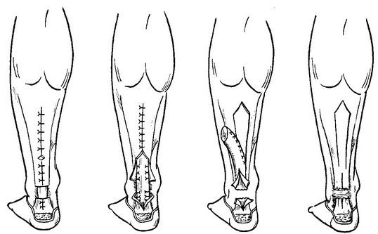 пластика ахіллового сухожилля за методом Чернавського