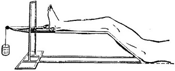 скелетне витяжіння за п'яткову кістку