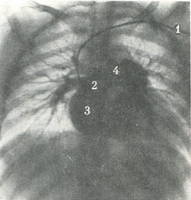 артеріальна фаза при загальній ангиопульмонографии