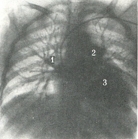 венозна фаза при загальній ангиопульмонографии