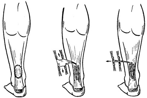 пластика ахіллового сухожилля з допомогою сухожилля довгої підошвової м'язи