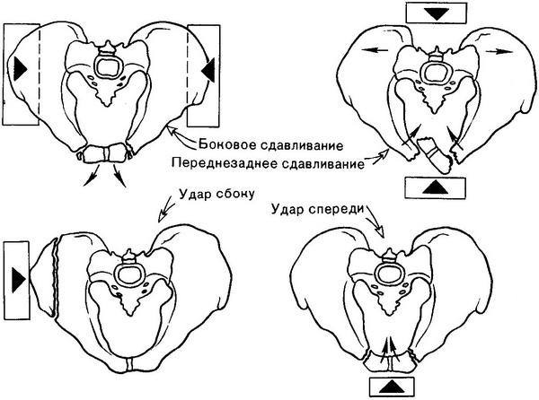переломи тазу
