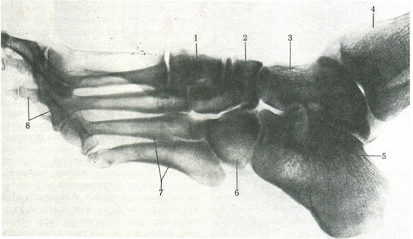 рентгенограма стопи