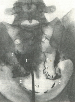 гисгеросальпингограмма
