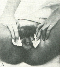 несправжній гермафродитизм