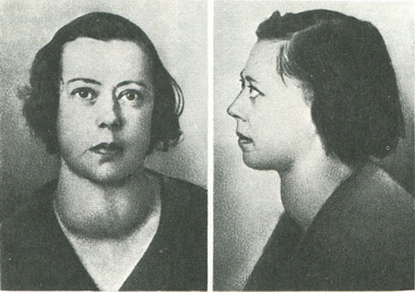 базедова хвороба