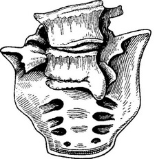 экзостоз на мисі