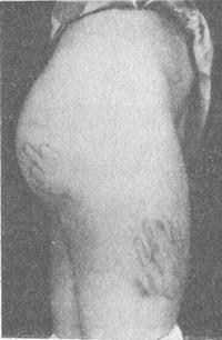 синець від удару долонею