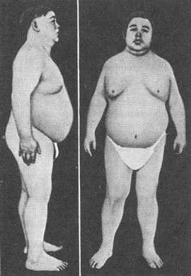 гіпотиреоїдизм