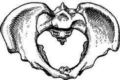 экзостоз на внутрішній поверхні лона