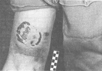 сліди від укусу зубами людини