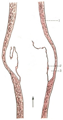 клапани в стегновій вені