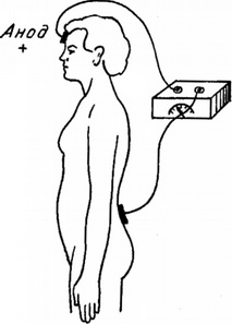 схема анодической гальванізації головного мозку