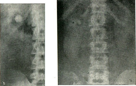області нирок і сечоводів