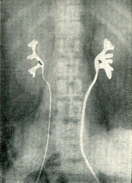 позанирковий і внутрипочечный тип ниркової миски