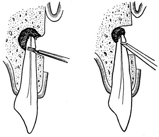 резекція верхівки кореня зуба