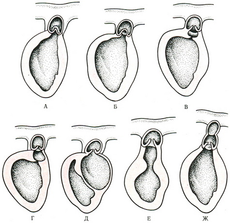 варіанти вродженого звуження отвору легеневого стовбура