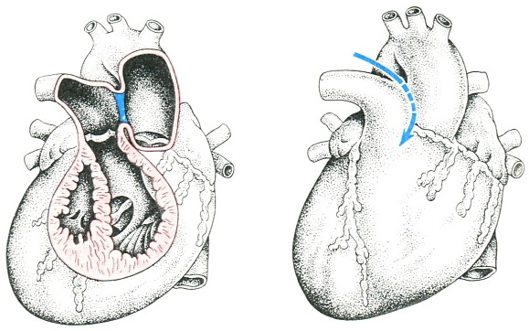 аортолегочное повідомлення
