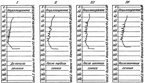 осцилограми артеріального тиску при анодической гальванізації головного мозку