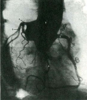 коронарографія серця