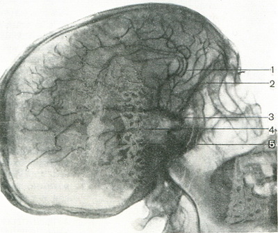 артериограмма мозку