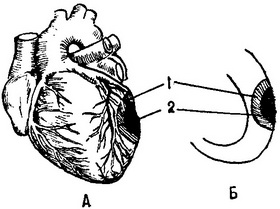 інфаркт міокарда
