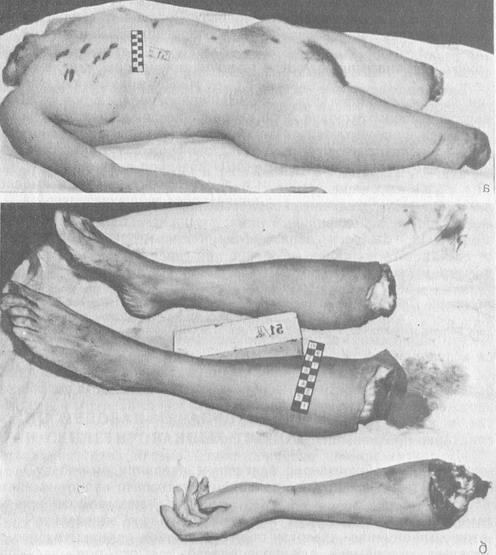 кримінальне розчленування трупа