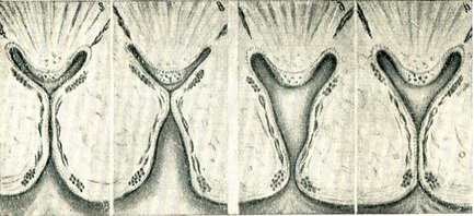 мала чашка під час діастоли і систоли