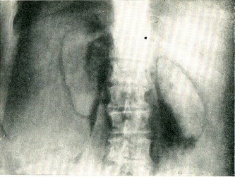 пневморетроперитонеум