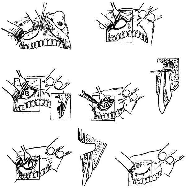 етапи гранулемэктомии