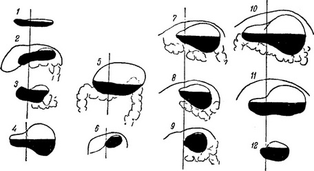 форми шлунка у дітей