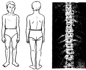 сколіоз 1 ступеня