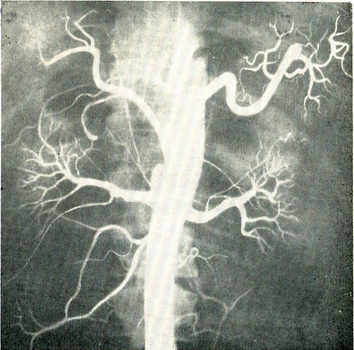 транслюмбальная ангіографія нирок