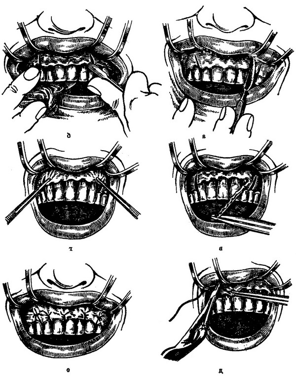 радикальна операція пародонтозу