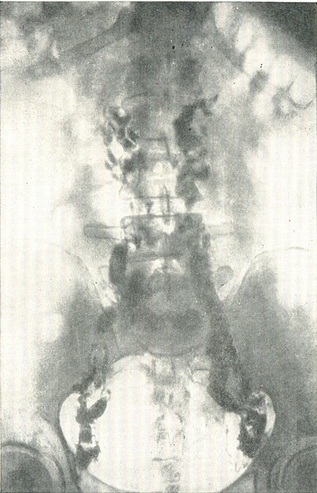 лимфограмма при пухлини сечового міхура