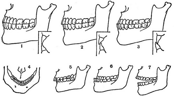 нормальний прикус