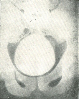 нормальна цистограмма