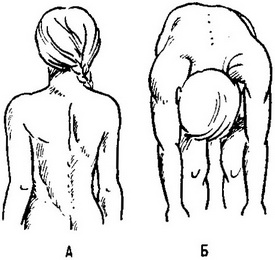 сколіоз 2 ступеня