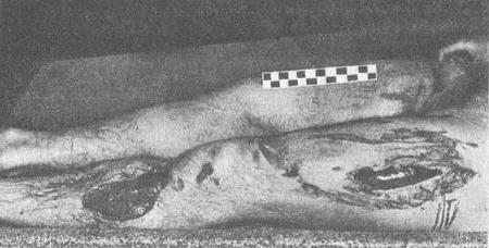 мотоциклетна травма